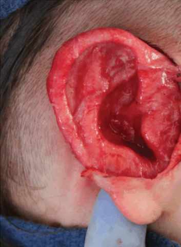 Surgery_flap ear