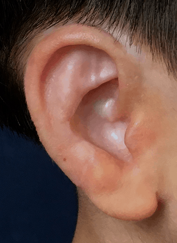 healed-ear
