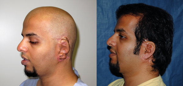 3_Failed Rib_B&A_LLAT
