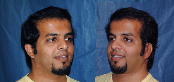 4_Failed Rib_AFTER34