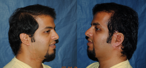 5_Failed Rib_AFTER_LAT