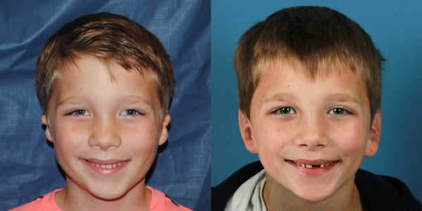 JOEY_B&A_AP