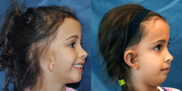 KIERA_B&A_RLAT