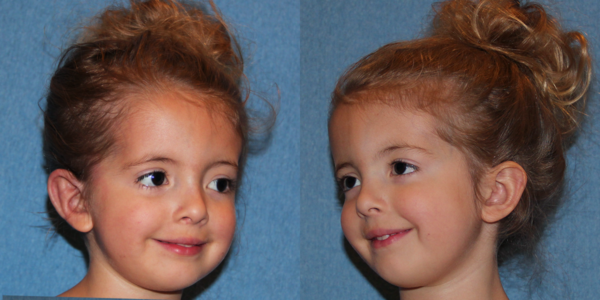 LAUREN_B&A_AFTER34