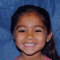 Right Medpor  2014 Aliyah