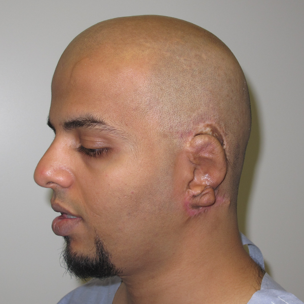 Adult Failed Rib Ear Left Medpor 2013
