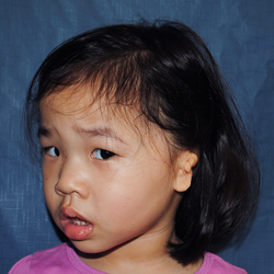 Left Medpor  2015 Sophie